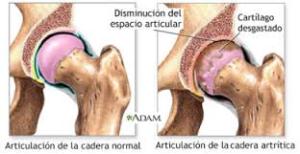 artrosis  de cadera